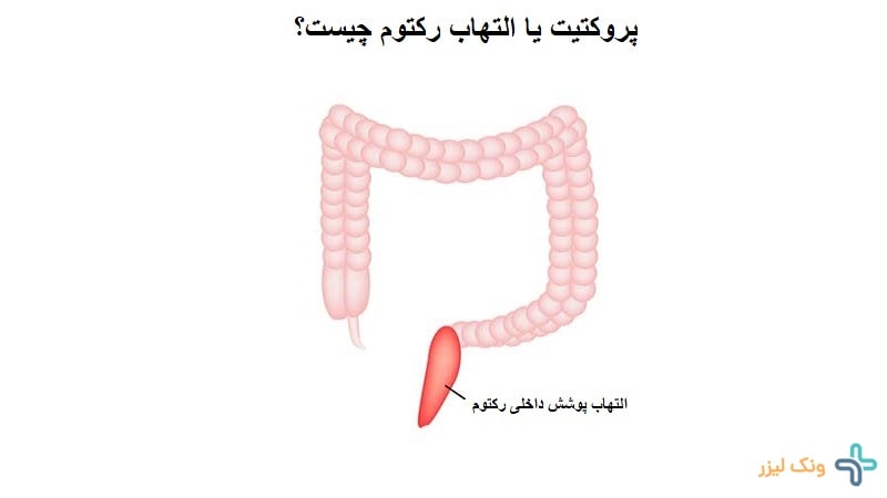 پروکتیت