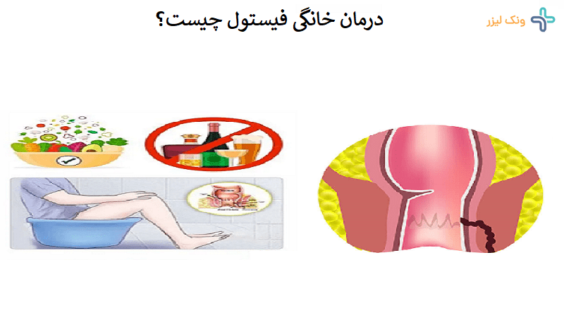درمان خانگی فیستول چیست