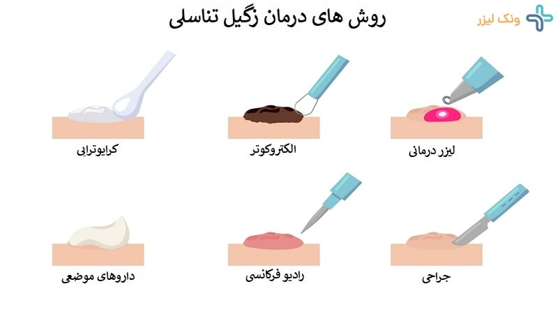 روش های درمان زگیل تناسلی