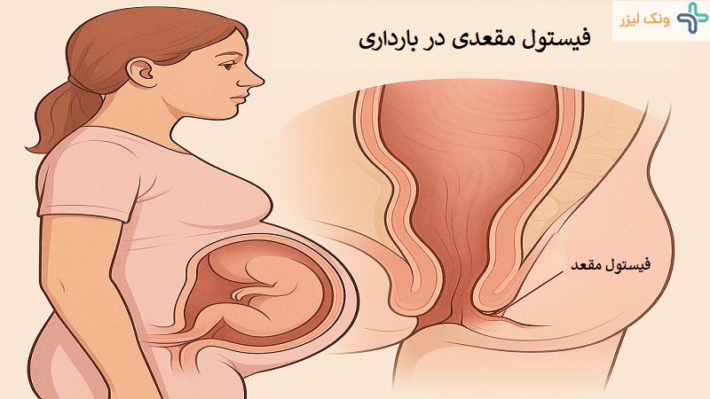 فیستول در بارداری