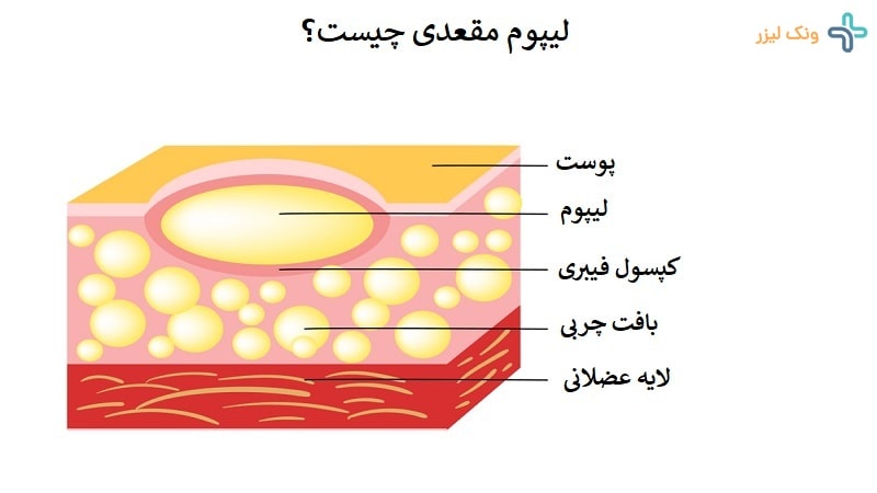 لیپوم مقعد