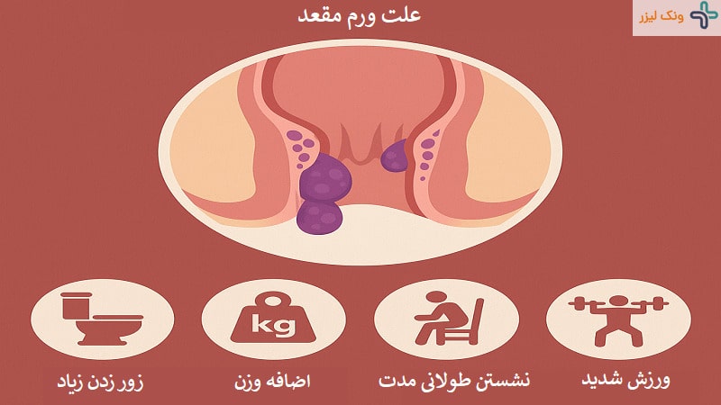 علت ورم مقعدی