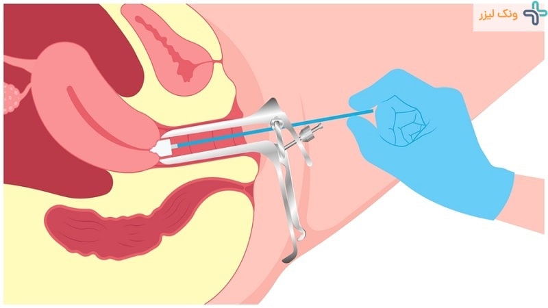 آزمایش HPV زنان