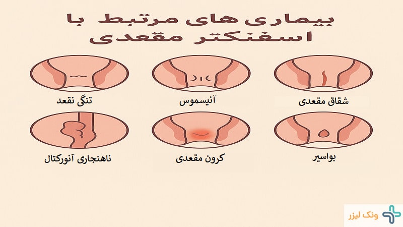 بیماری های اسفنکتر مقعدی