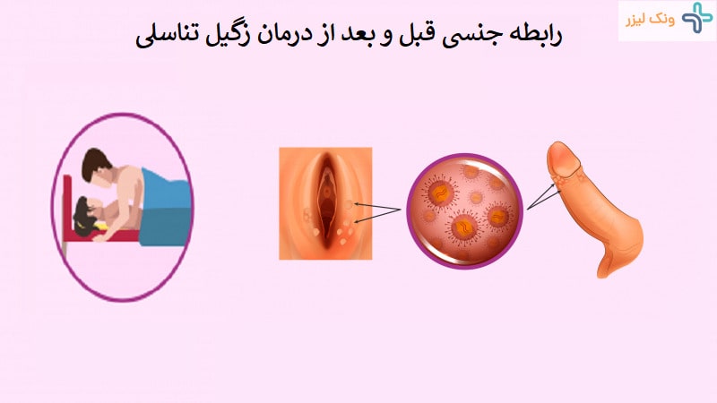 رابطه جنسی و زگیل تناسلی