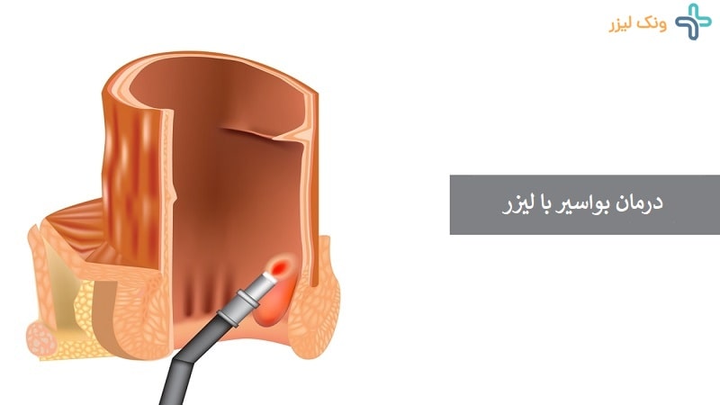 لیزر هموروئید