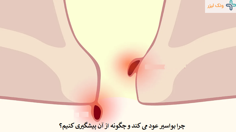 عود بواسیر