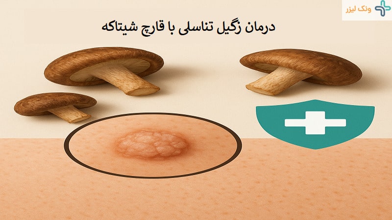 قارچ شیتاکه درمان زگیل تناسلی
