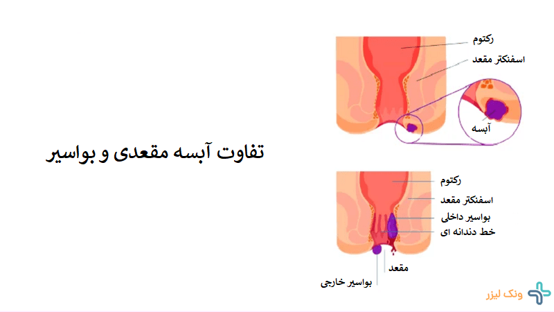 تفاوت آبسه مقعدی و بواسیر