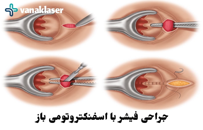 عکس نحوه جراحی شقاق با اسفنکتروتومی باز
