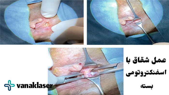 عکس عمل شقاق با اسفنکتروتومی بسته