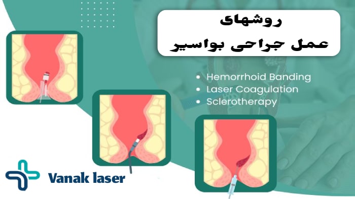 آیا عمل بواسیر سخته؟